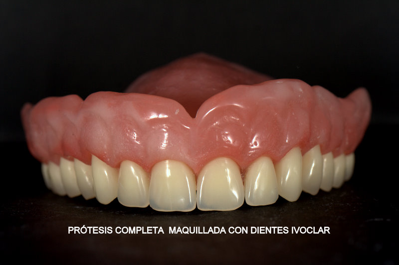 Emborracharse fuga de la prisión huella dactilar protesis completa superior maquillada con dientes Ivoclar - Delta Ebre  Clínica Dental