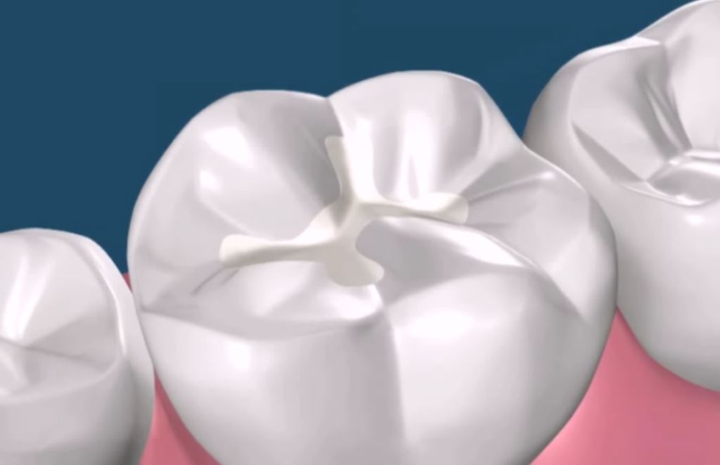 Sellado de fosas y fisuras - Delta Ebre Clínica Dental